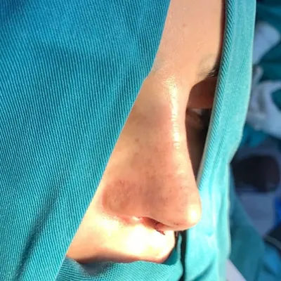 تجربتي ترميم الأنف د.اشعري profile