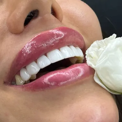 کامپوزیت _لمینت_بدون تراش🦷😍 profile