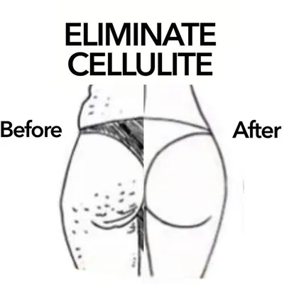 Eliminate Cellulite ๐๐
profile