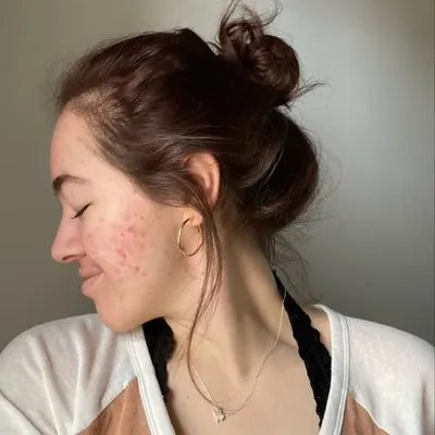 skin positivity & self love profile