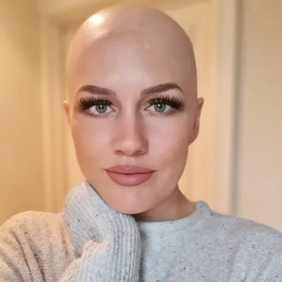 The Hair Girl | Alopecia profile